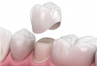 Протезирование