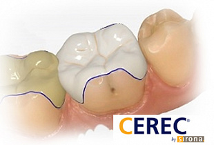 Реставрация CEREC
